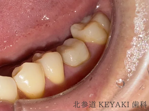 Before: 奥歯の被せ物を綺麗に治したいので来院され、補綴治療を行いました。