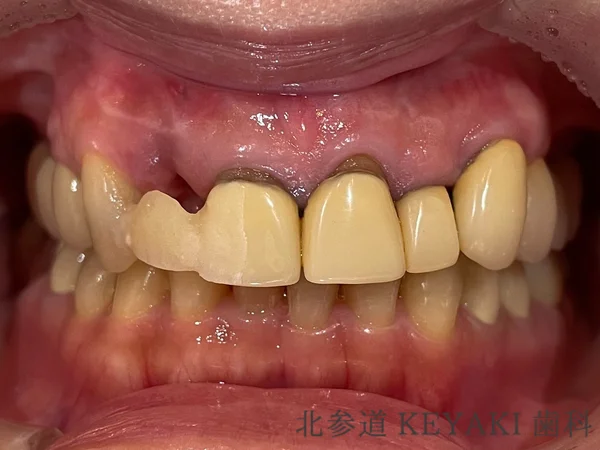 Before: 昔の被せ物を新しく綺麗にしたいので来院され、補綴治療を行いました。