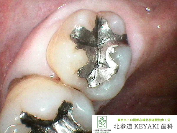 Before: 金属の詰め物が気になる・虫歯を治したいで来院され、虫歯治療を行いました。