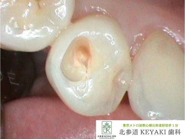 Before: 右下の変色が気になるで来院され、虫歯治療を行いました。