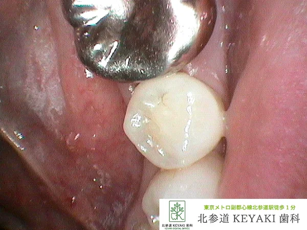 After: 左下の変色が気になるで来院され、虫歯治療を行いました。
