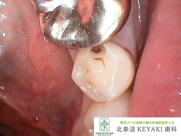 Before: 左下の変色が気になるで来院され、虫歯治療を行いました。