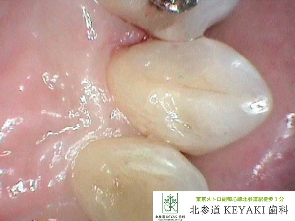 After: 虫歯を治したいで来院され、虫歯治療を行いました。