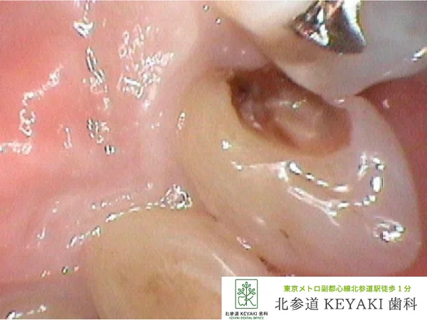 Before: 虫歯を治したいで来院され、虫歯治療を行いました。